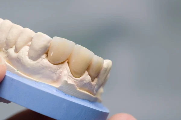 Yapay diş diş laboratuarında diş bir baskı üzerinde — Stok fotoğraf