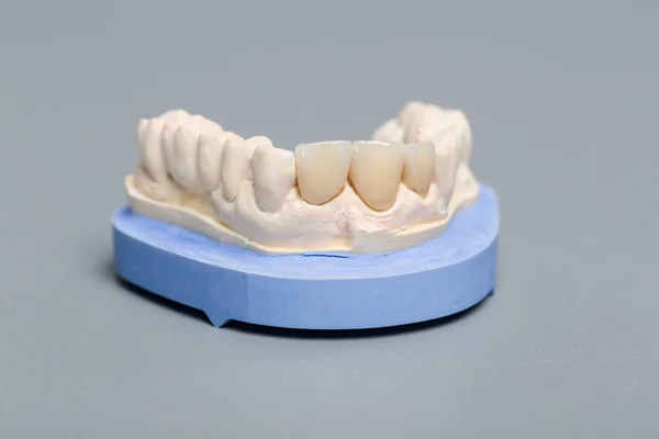 Dentición artificial en una huella dental en un laboratorio dental — Foto de Stock