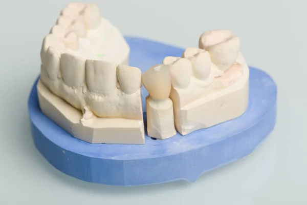 Impronta Dentale Con Dentizione Artificiale Laboratorio Odontoiatrico Pronto All Uso — Foto Stock