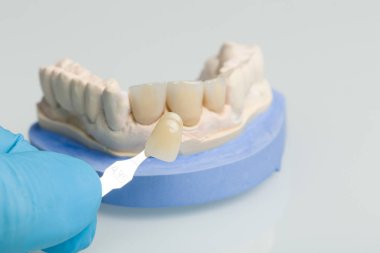 Diş laboratuarında diş taç kaplama kontrol etmek için protez gölge Kılavuzu kullanma