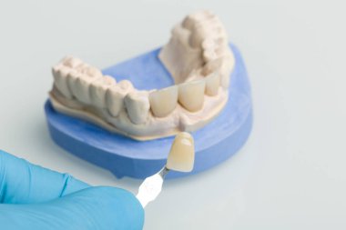 Diş laboratuarında diş taç kaplama kontrol etmek için protez gölge Kılavuzu kullanma