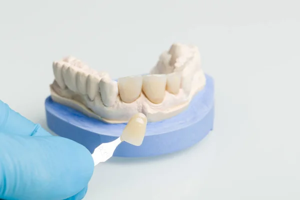 牙科实验室义齿用遮阳指南检查牙冠单板 — 图库照片