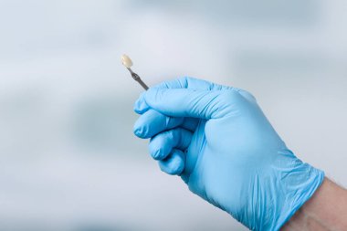 Diş kaplamakontrol etmek için gölge kılavuzu ile Diş hekimi eli 