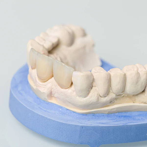 Primer plano de las piezas dentales en el laboratorio dental — Foto de Stock