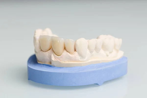 Primo piano delle parti della protesi nel laboratorio dentale — Foto Stock