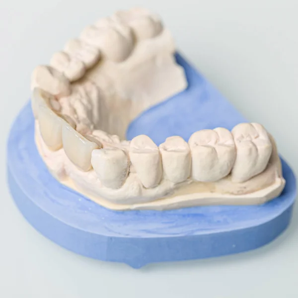 Primo piano delle parti della protesi nel laboratorio dentale — Foto Stock