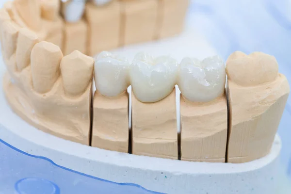 Primo Piano Della Dentizione Artificiale Impronta Dentale Laboratorio Dentistico — Foto Stock