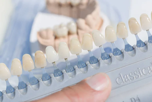 Zbliżenie Okleiny Kontrolnej Sztucznego Uzębienia Nadruku Dentystycznym Laboratorium Stomatologicznym — Zdjęcie stockowe