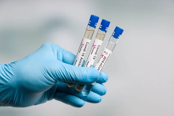 Hand Blue Gloves Holding Three Corona Test Tubes Result Markers — Stock Photo, Image