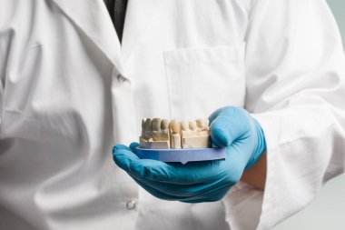 Diş teknisyeninin eldiven içindeki elini kapat. Kullanıma hazır yapay dişli bir diş izi göster.