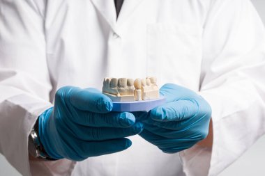 Diş teknisyeninin eldiveni kullanıma hazır yapay dişli bir diş izi gösteriyor.