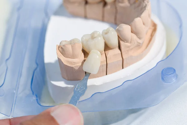 close up of checking veneer of tooth crown or implant with a sha