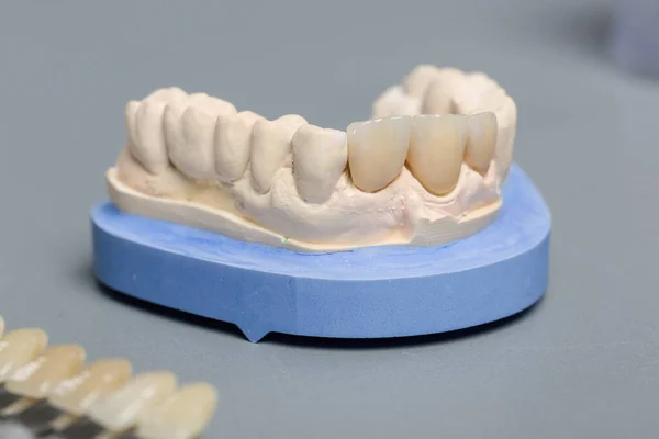 Primo Piano Del Controllo Impiallacciatura Della Corona Del Dente Impianto — Foto Stock