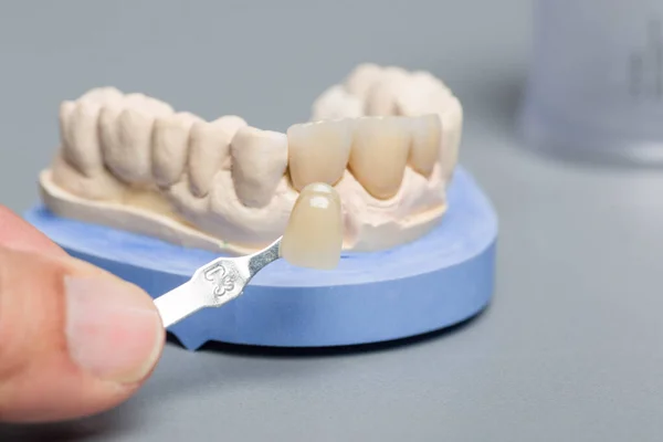 Primo Piano Del Controllo Impiallacciatura Della Corona Del Dente Impianto — Foto Stock