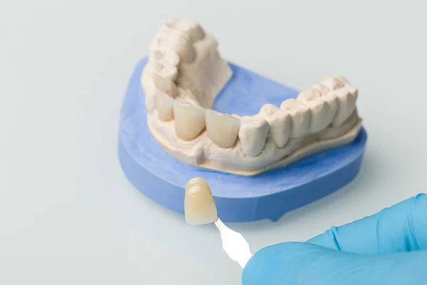 Primo Piano Del Controllo Impiallacciatura Della Corona Del Dente Impianto — Foto Stock