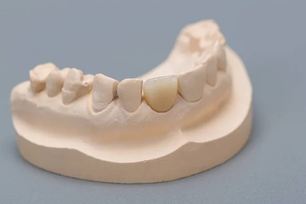 Primer Plano Manipulación Listo Para Uso Dentición Artificial Popa — Foto de Stock