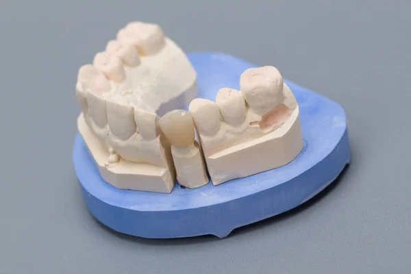 Primer Plano Manipulación Listo Para Uso Dentición Artificial Popa — Foto de Stock