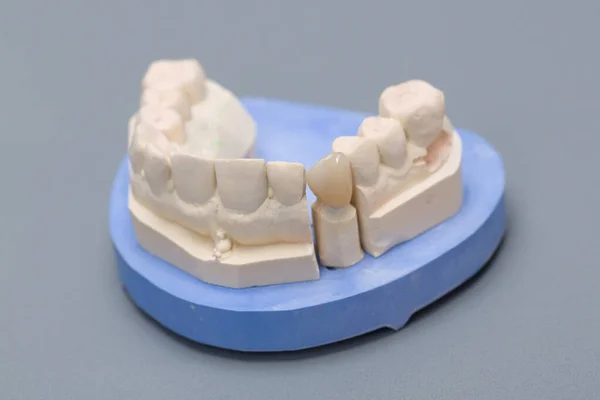 Primer Plano Manipulación Listo Para Uso Dentición Artificial Popa — Foto de Stock