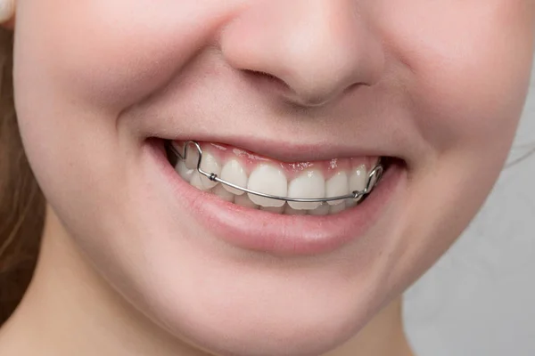 Chica Joven Está Sonriendo Muestra Abrazadera Dental Extraíble — Foto de Stock