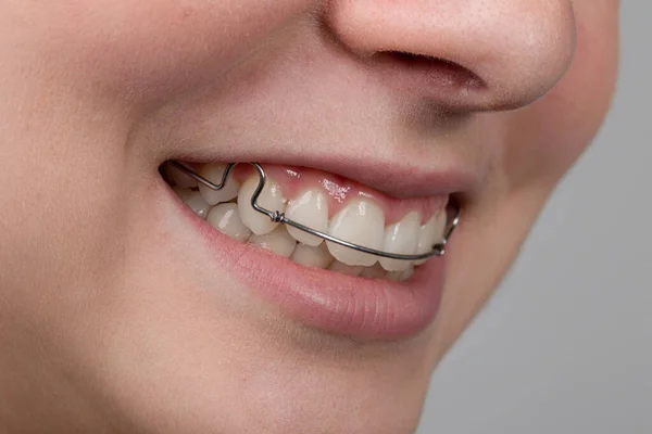 Jovem Está Sorrindo Mostra Sua Cinta Dental Removível — Fotografia de Stock