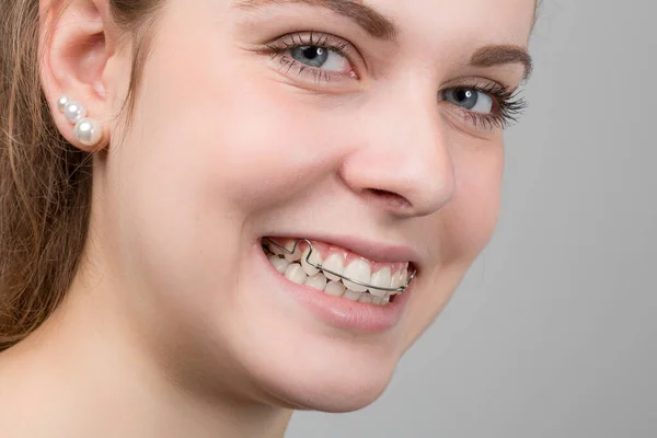 Chica Joven Está Sonriendo Muestra Abrazadera Dental Extraíble — Foto de Stock