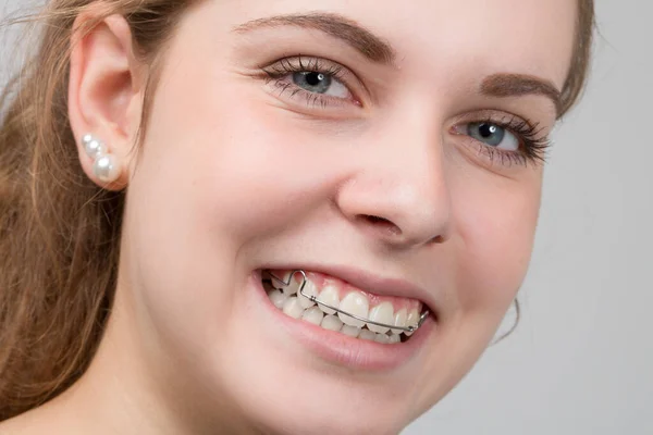 Молода Дівчина Посміхається Показує Свою Знімну Зубну Дужку — стокове фото