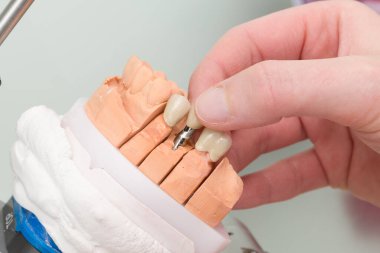 Bir eklem makinesi / protez eyere diş implantı takmak