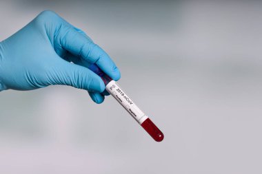 Bir laboratuarın önünde elinde kan testi tüpü tutan mavi eldivenler. 