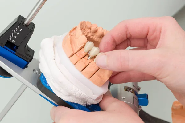 Montage Implant Dentaire Sur Une Selle Articulateur Prothèse — Photo