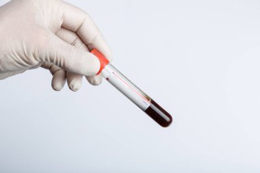 Kan örneğiyle birlikte doktorun eli.