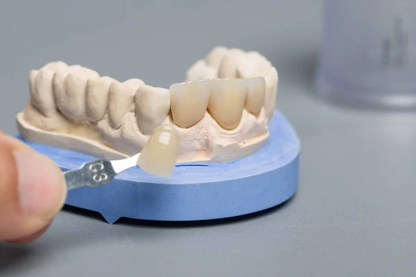 Primo Piano Del Controllo Impiallacciatura Della Corona Del Dente Impianto — Foto Stock