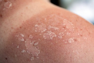 Peeling cilt, sırt ve omuz güneş yanığı etkisi