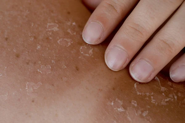 Peeling huid op terug en schouder van zonnebrand effect — Stockfoto