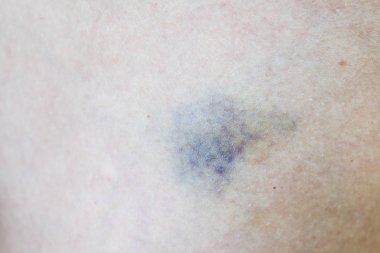 Cilt taze bir yara üzerinde kapat