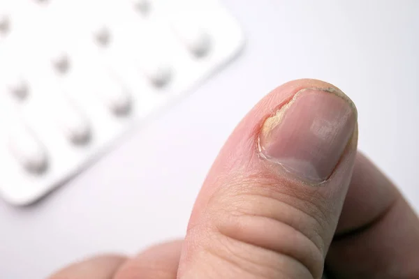 Close up van nagel schimmel infectie op de duim vinger — Stockfoto