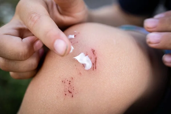Poner ungüento en la piel rascada en la rodilla del niño, el cuidado de la lesión después de caer — Foto de Stock