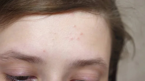 Lány dörzsöli a szalvétát a homlokán. közelről. Kozmetikai eljárások a tizenévesek számára. Tizenéves lányok alkalmazni egy hidratáló arckrém akne. — Stock Fotó