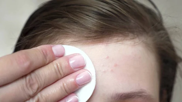 Meninas adolescentes aplicam um creme hidratante para acne. A rapariga esfrega a testa com um guardanapo. Procedimentos cosméticos para adolescentes. close-up — Fotografia de Stock