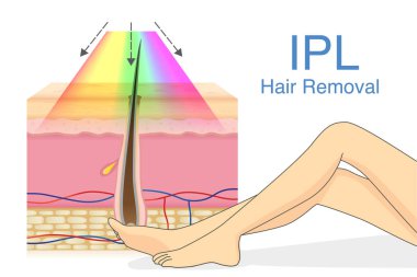 IPL epilasyon cilt katman ve kadın bacak için ışık. Resimde kozmetik teknolojisi hakkında.