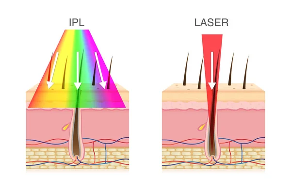 Der Unterschied Zwischen Der Verwendung Von Ipl Licht Und Laser — Stockvektor