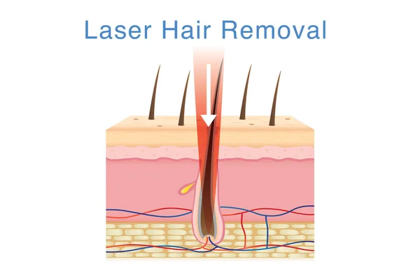 レーザー脱毛皮膚の層上の光 化粧品技術について図 — ストックベクタ