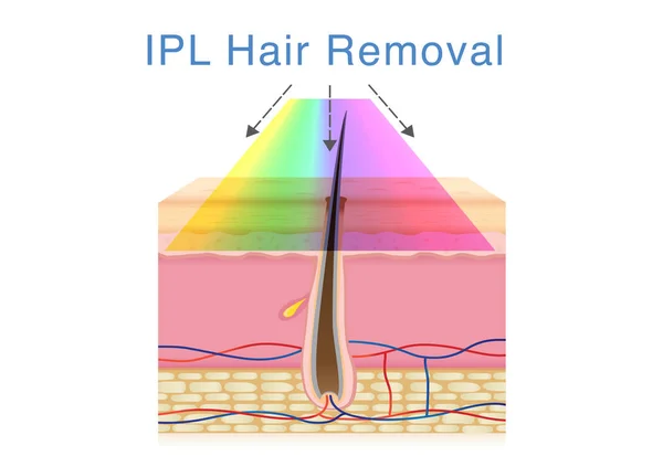 人間の皮膚の毛の取り外しのための Ipl の光を使用してください 美容技術について図 — ストックベクタ