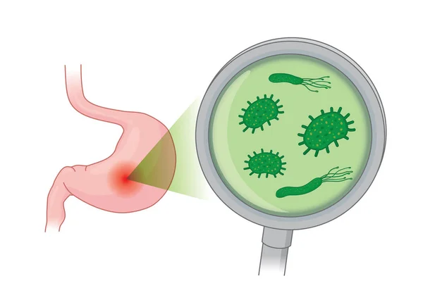 虫眼鏡で 人間の胃の中の細菌を探しています 健康管理と医療についての概念図 — ストックベクタ