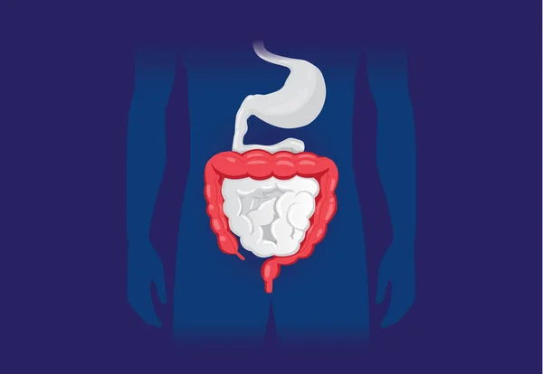 人間の大腸の異常な症状についての図 消化器系の病気 — ストックベクタ