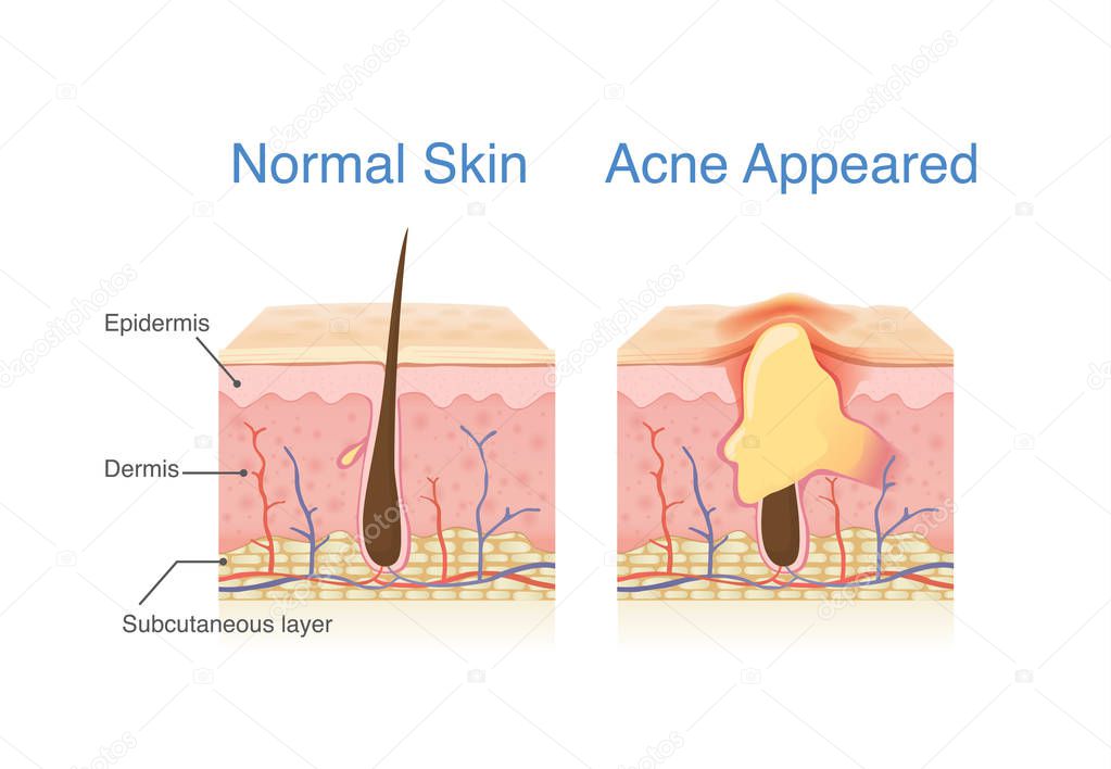 Difference of Normal skin layer and skin layer with Acne. Illustration about dermatology diagram.