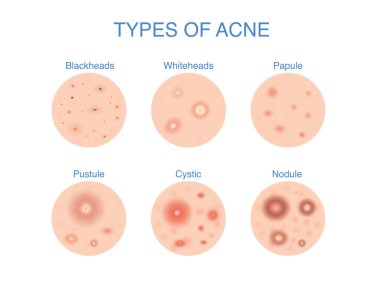 Types of Acne icon for skin problems content. Illustration about dermatology diagram. clipart