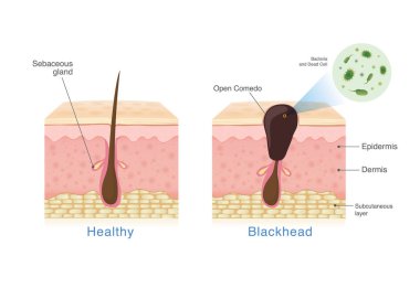 Bacteria in blackhead with human skin layer structure and Healthy skin. Illustration about dermatology diagram. clipart