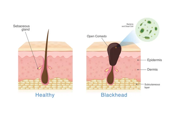 Bacteria Blackhead Human Skin Layer Structure Healthy Skin Illustration Dermatology — Stock Vector