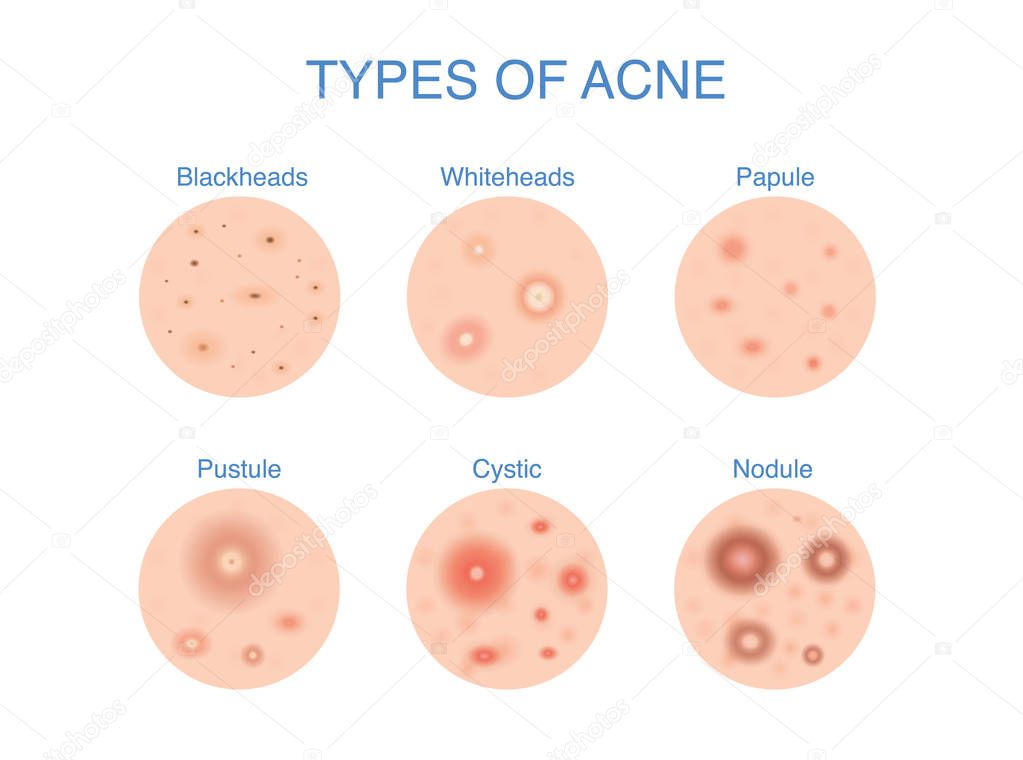 Types of Acne icon for skin problems content. Illustration about dermatology diagram.
