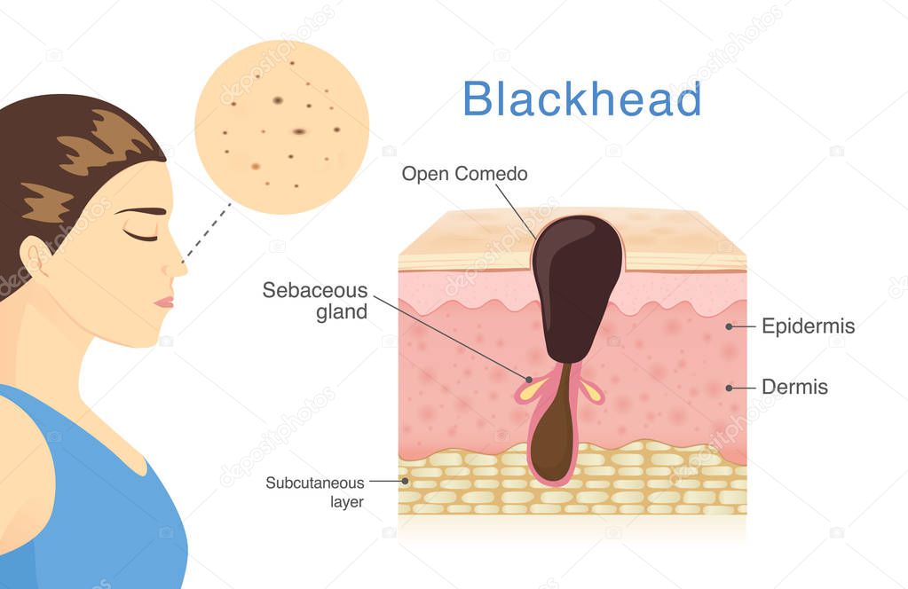 Woman have Blackhead Acne on her nose with skin layer and description. Illustration about medical diagram.